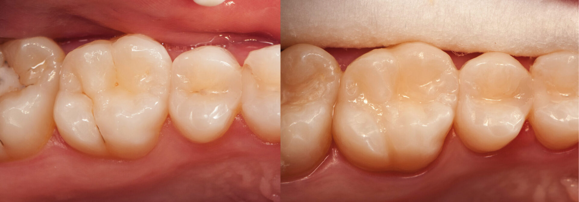 Before and after sealants